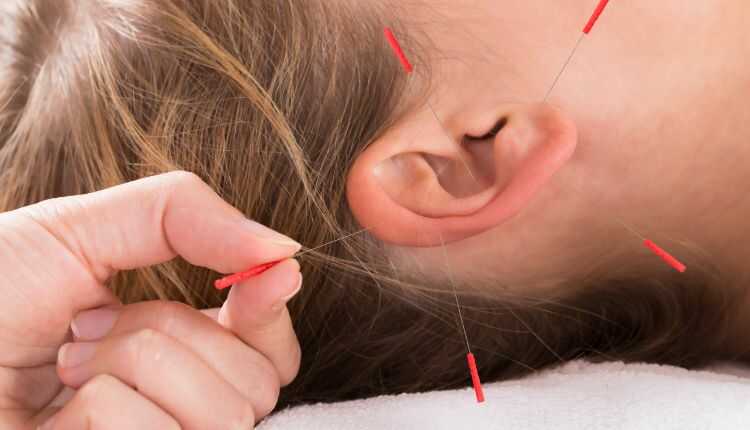 akupunktur-tedavisi